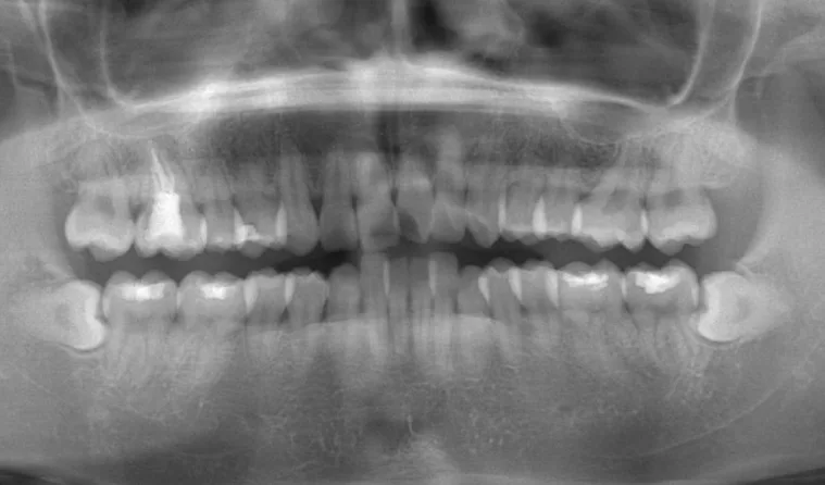 日本歯科グループの症例写真・治療前