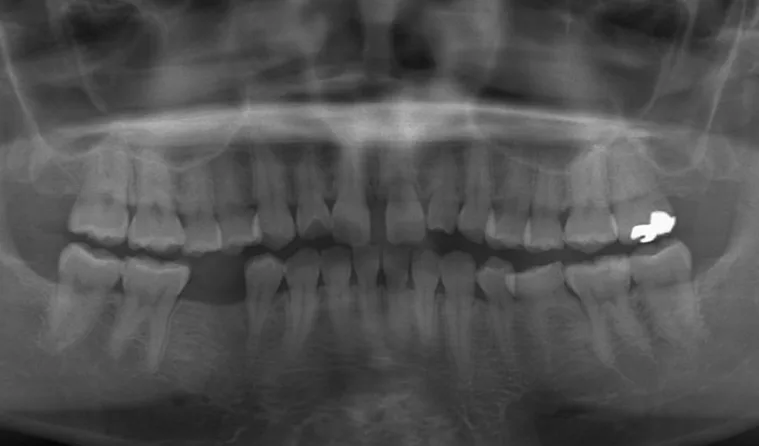 日本歯科グループの症例写真・治療前